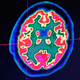 A picture of a human brain taken by a positron emission tomography scanner, also called a PET scan.